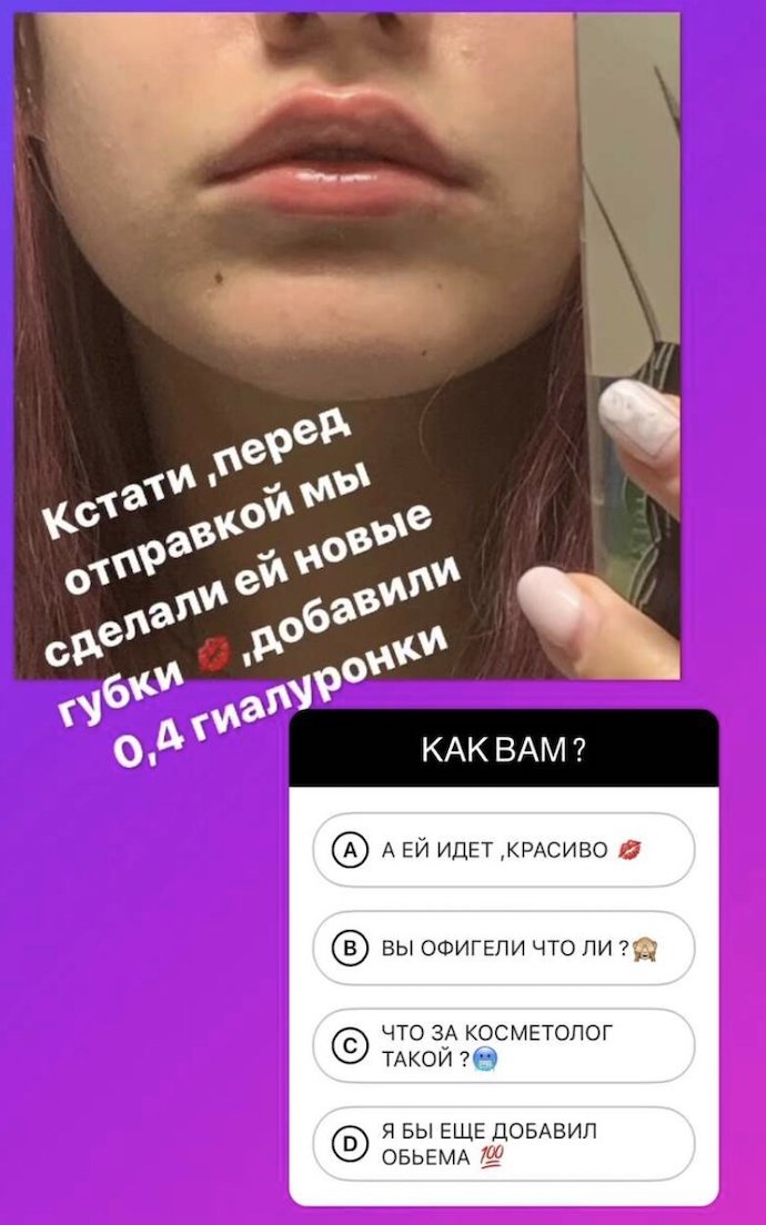 «Добавили гиалуронки»: Дана Борисова попросила оценить «новые» губы 15-летней дочери 